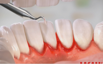 Werbespot lacalut Aktiv